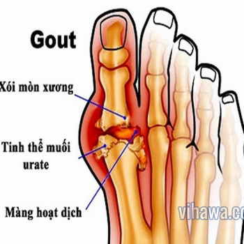 Bữa ăn hàng ngày đối với bệnh nhân mắc bệnh gout