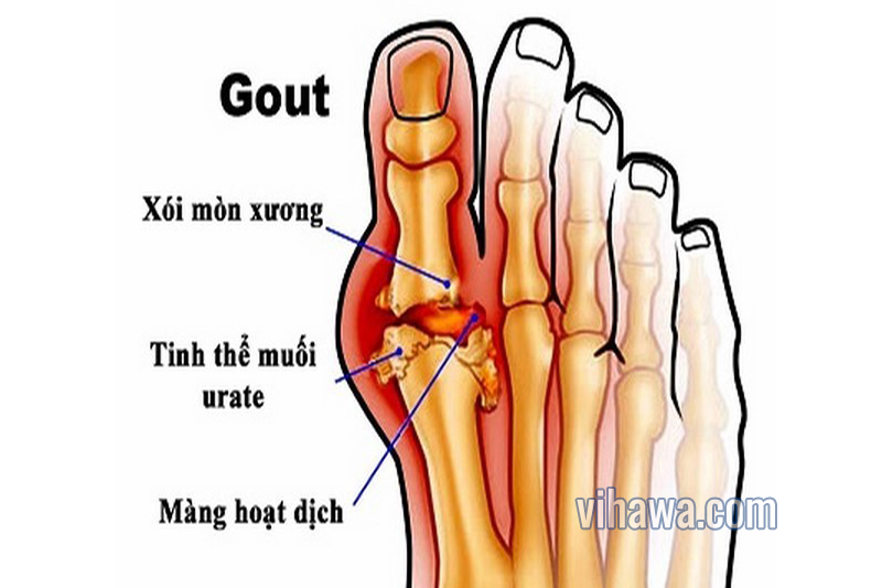 Bệnh gout